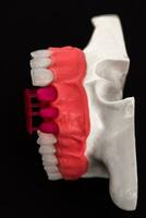 les dents implant et couronne installation processus les pièces isolé sur une bleu Contexte. médicalement précis 3d modèle. photo