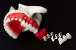 les dents implant et couronne installation processus les pièces isolé sur une noir Contexte. médicalement précis 3d modèle. photo