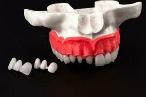 les dents implant et couronne installation processus les pièces isolé sur une noir Contexte. médicalement précis 3d modèle. photo