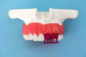 les dents implant et couronne installation processus les pièces isolé sur une bleu Contexte. médicalement précis 3d modèle. photo