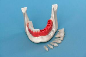 les dents implant et couronne installation processus les pièces isolé sur une bleu Contexte. médicalement précis 3d modèle. photo