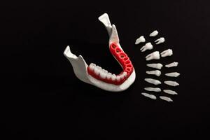 les dents implant et couronne installation processus les pièces isolé sur une noir Contexte. médicalement précis 3d modèle. photo