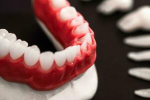 les dents implant et couronne installation processus les pièces isolé sur une noir Contexte. médicalement précis 3d modèle. photo