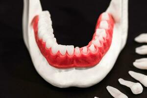 les dents implant et couronne installation processus les pièces isolé sur une noir Contexte. médicalement précis 3d modèle. photo
