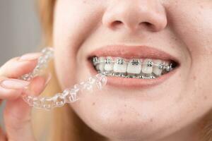 dentaire soins.souriant fille avec un appareil dentaire sur sa les dents détient aligneurs dans sa mains et spectacles le différence entre leur photo