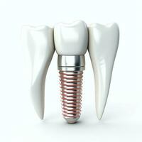 proche en haut de une dentaire dent implant ou en bonne santé Humain dents. blanc émail et dentaire implants chirurgie concept par ai généré photo