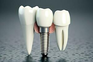 proche en haut de une dentaire dent implant ou en bonne santé Humain dents. blanc émail et dentaire implants chirurgie concept par ai généré photo