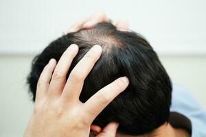 chauve tête dans homme, cheveux perte traitement santé problème. photo