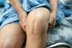 asiatique personnes âgées femme patient spectacle sa cicatrices chirurgical total le genou mixte remplacement suture blessure chirurgie arthroplastie sur lit dans allaitement hôpital salle, en bonne santé fort médical concept. photo