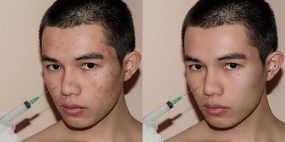 jeune homme avec traitement avant et après de l'acné et du bouton. photo