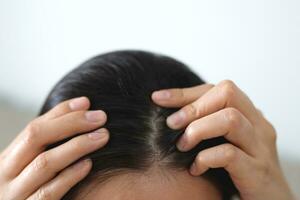 une femme a problèmes avec cheveux et cuir chevelu, elle a pellicules de allergique réactions à shampooings. et cheveux Conditionneur photo