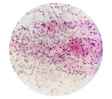 photomicrographie de Pap diffamer montrant inflammatoire diffamer avec hpv en relation changements. cervical cancer. csc photo