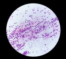 photomicrographie de Pap diffamer montrant inflammatoire diffamer avec hpv en relation changements. cervical cancer. csc photo