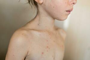 obscurci visage de peu fille avec varicelle, varicelle virus ou vésiculaire éruption cutanée, fermer photo