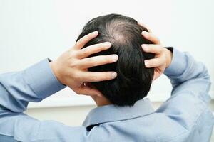 chauve tête dans homme, cheveux perte traitement santé problème. photo