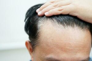 chauve tête dans homme, cheveux perte traitement santé problème. photo