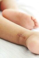 cousu blessure marque sur une enfant pied. photo