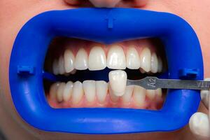 procédure pour comparant le Couleur nuances de les dents en utilisant tests avant blanchiment photo