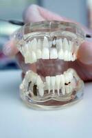 médecin orthodontiste détient dans le sien main une modèle de les dents avec implants photo