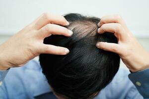 chauve tête dans homme, cheveux perte traitement santé problème. photo