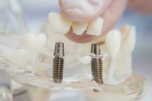 orthodontiste spectacles Comment à insérer le implant. macro photo