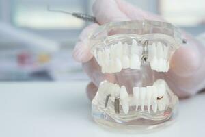 médecin orthodontiste détient dans le sien main une modèle de les dents avec implants photo