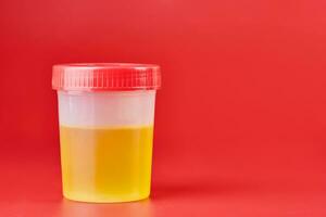 analyse d'urine pour lithiase urinaire en récipient photo