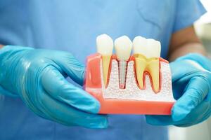 médecin tenir dentaire implant, artificiel dent les racines dans mâchoire, racine canal de dentaire traitement, gencive maladie, les dents modèle pour dentiste en train d'étudier à propos dentisterie. photo