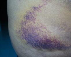 ecchymose sur la peau de la fesse blessure due à un accident à la maison. photo