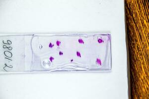 tranches de le tumeur en dessous de verre. histologique examen de tumeur cellules pour le présence de cancer photo