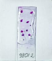 tranches de le tumeur en dessous de verre. histologique examen de tumeur cellules pour le présence de cancer photo