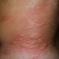 allergie peau retour et côtés. allergique réactions sur le peau dans le forme de gonflement et rougeur photo