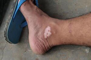 le pieds de une Jeune asiatique homme qui expériences démangeaisons dans le jambe zone et feuilles longue cicatrices photo
