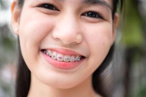 portrait de une Jeune asiatique femme avec un appareil dentaire sur sa les dents photo