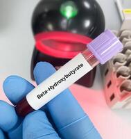 du sang échantillon pour bêta-hydroxybutyrate ou bhb test. utilisé à détecter cétones à identifier les patients Souffrance de diabétique acidocétose. photo