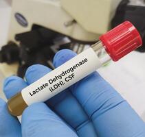 csf échantillon pour ldh ou lactate déshydrogénase test. photo