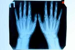 X rayon de le mains, une image de le des os de le mains sur le radiographie. photo