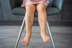 proche en haut de taches bleu blessure sur jambes de peu fille. extravasation bleu, violet sur peau. actif enfance concept photo