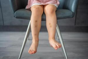 proche en haut de taches bleu blessure sur jambes de peu fille. extravasation bleu, violet sur peau. actif enfance concept photo