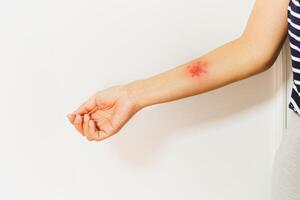 zona, zoster ou herpès zoster symptômes sur les femmes bras isolé. photo