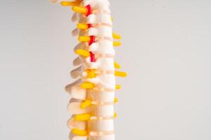 lombaire colonne vertébrale déplacé hernie disque fragment, spinal nerf et os. modèle pour traitement médical dans le orthopédique département. photo