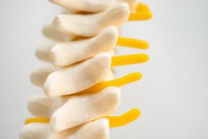 lombaire colonne vertébrale déplacé hernie disque fragment, spinal nerf et os. modèle pour traitement médical dans le orthopédique département. photo