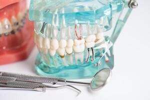 dentaire implant, artificiel dent les racines dans mâchoire, racine canal de dentaire traitement, gencive maladie, les dents modèle pour dentiste en train d'étudier à propos dentisterie. photo