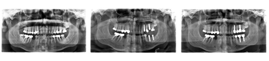 X rayon de les dents photo
