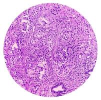 prostatique tissu biopsie. sections spectacle spectacle gras tissu, neural tissu et muscle tissu. prostate cancer diagnostic. photo