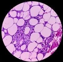 lipome sur cubital fosse, bénin croissance de gras tissu, bénin néoplasme, les adipocytes, partiellement encapsulé tumeur, 40x microscopique voir. photo