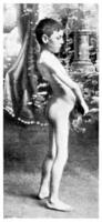 progressive musclé dystrophie, ancien gravure. photo