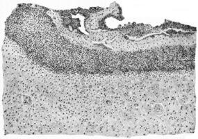 section de Humain cerveau comprenant mur de cérébral abcès, ancien gravure. photo