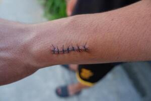 cicatrices cette avoir été cousu après chirurgie sur le bras photo