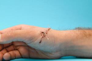 suture blessure sur main de dermatologie procédure photo